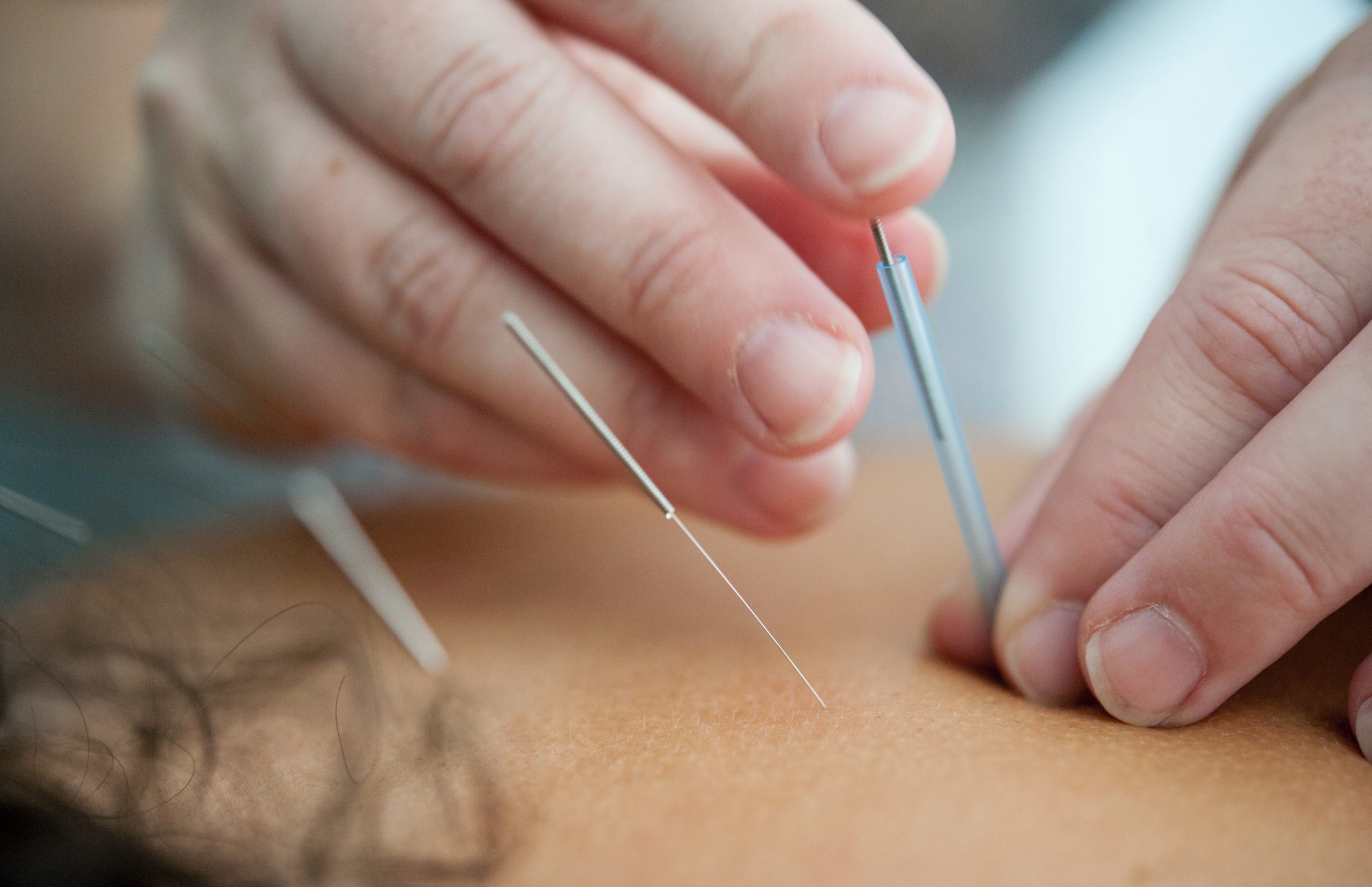 Akupunktur und Moxatherapie